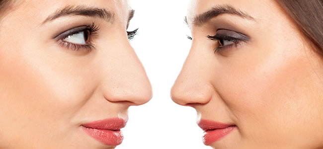 Rinoplastia: Un cambio radical en tu rostro