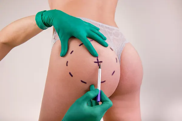 El aumento de glúteos es uno de los procedimientos estéticos más buscados actualmente y entre las opciones más populares se encuentra la gluteoplastia con grasa, una técnica...